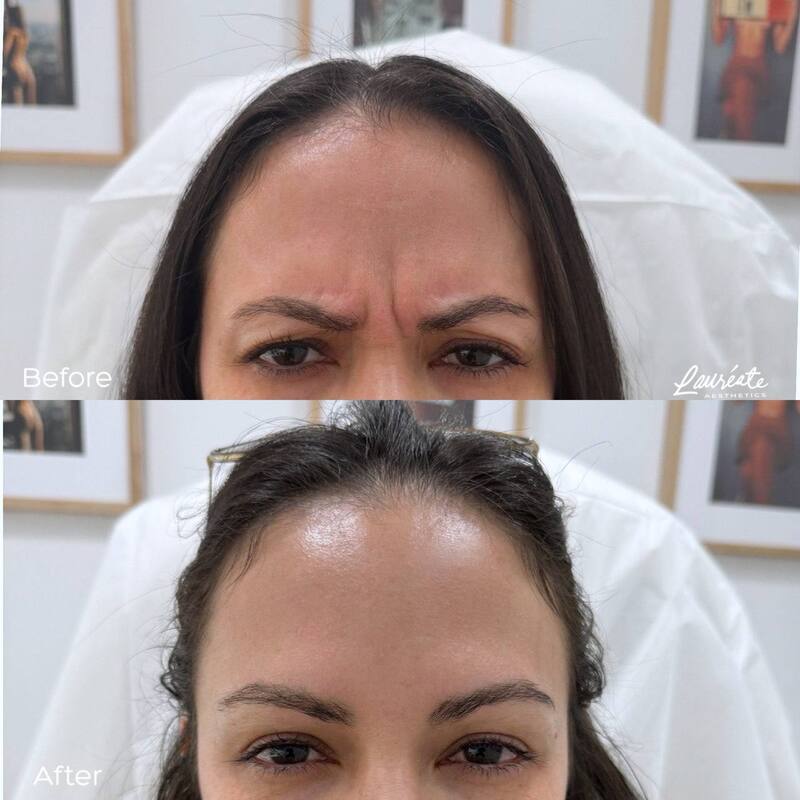 Before and after Botox for forehead frown lines