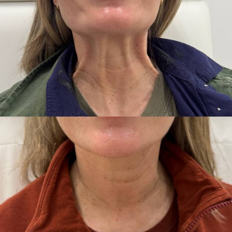 Botox treatment for neck bands