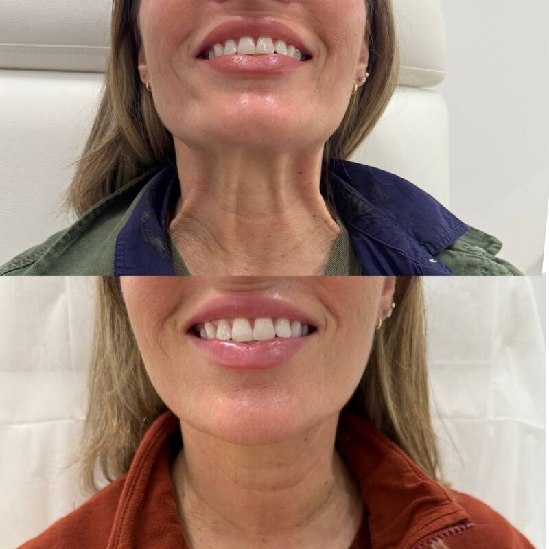 Botox before and after for neck tightening