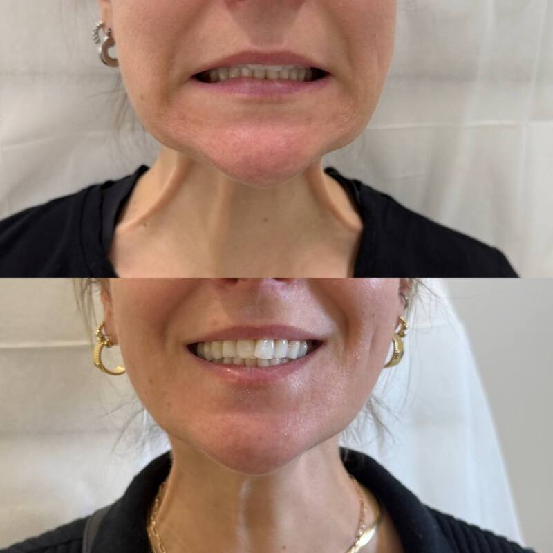 Before and after Botox neck bands