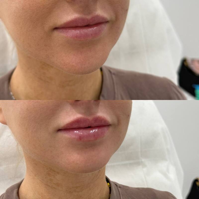 Lip enhancement results with Botox