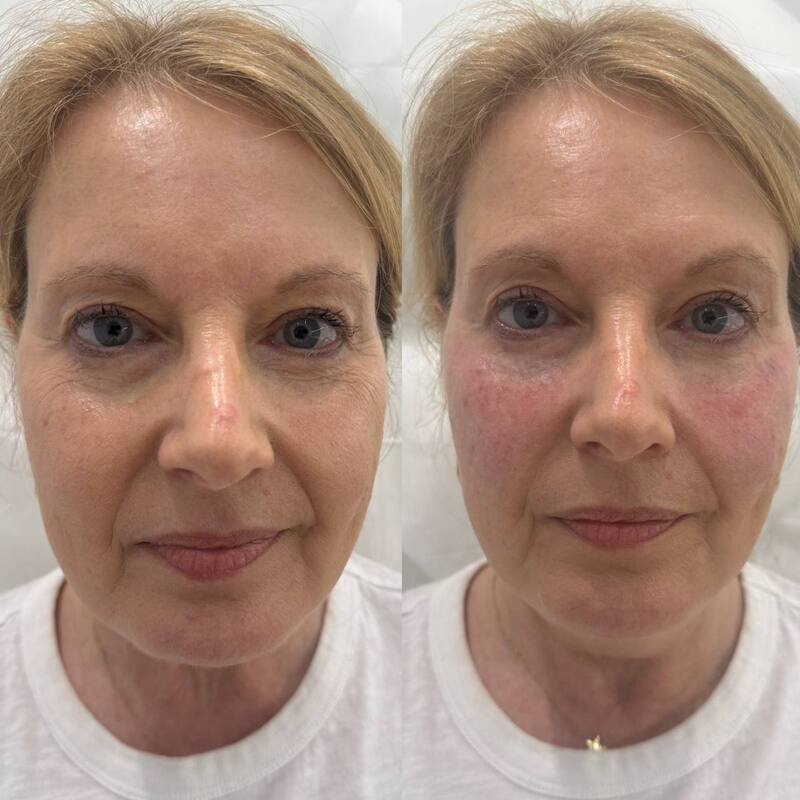 Under eyes Botox before and after